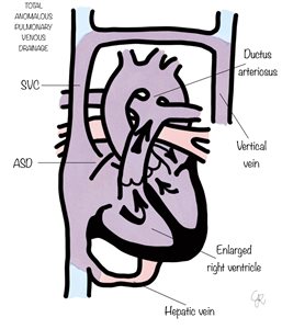 total anomalous pulmonary venous drainage