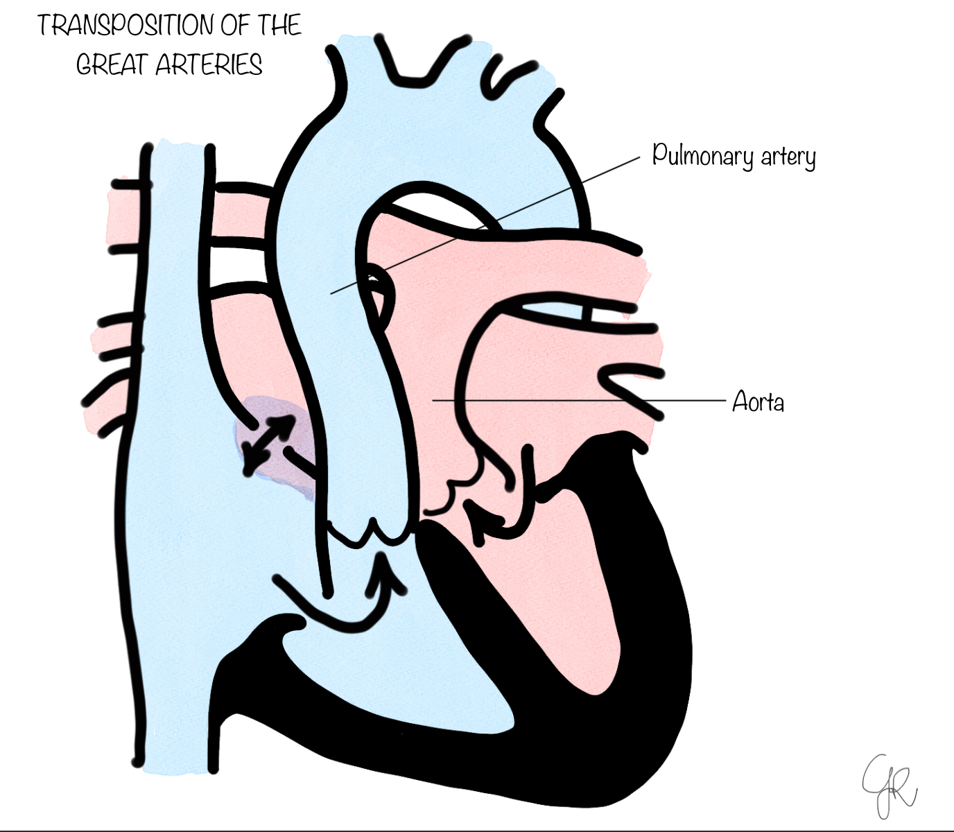 Transposition of the Great Arteries