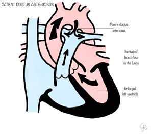 patent ductus arteriosus