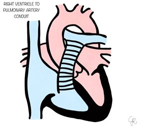 right ventricle to pulmonary artery conduit