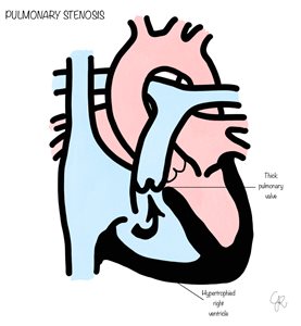 pulmonary stenosis