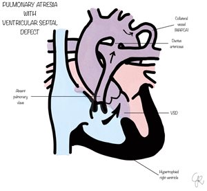 pulmonary atresia with ventricular septal defect