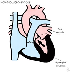 congenital aortic stenosis
