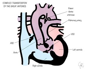 complex transposition of great arteries