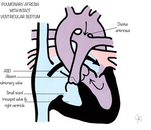 pulmonary atresia with intact ventricular septum